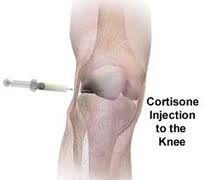 Knee steroid injection technique