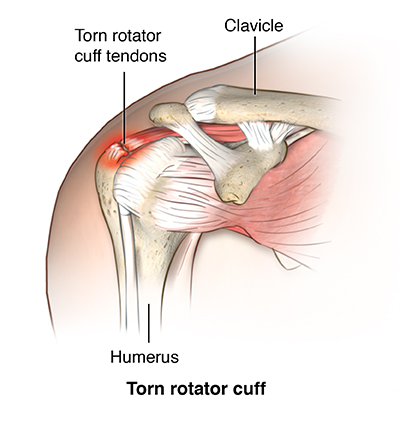 radial cuff