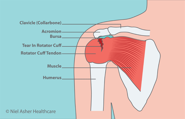 rotator cuff symptoms treatment