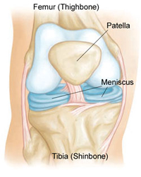 Torn Meniscus - Repair and Post Op Instructions - Connecticut