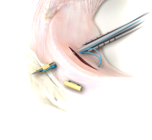 Meniscus Repair