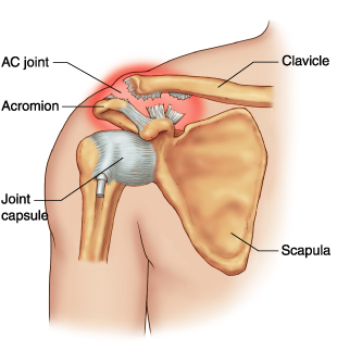 boom Bøje berømt Acromioclavicular (AC) Joint Dislocation / Separation