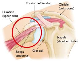 Tendonitis deals upper arm