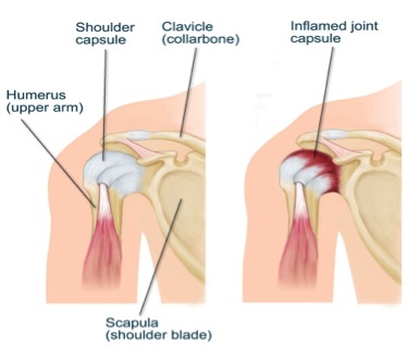 Best Massages for Treating A Frozen Shoulder