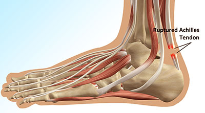 Achilles Tendon Tear Symptoms, Causes & Treatment