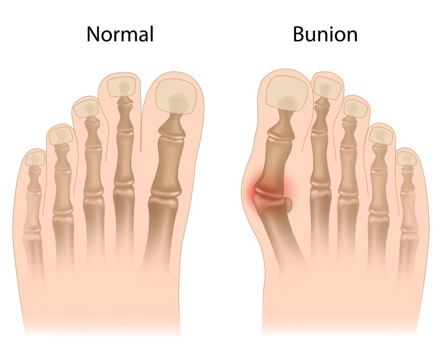 Physical Therapist's Guide to Bunion (Hallux Valgus)