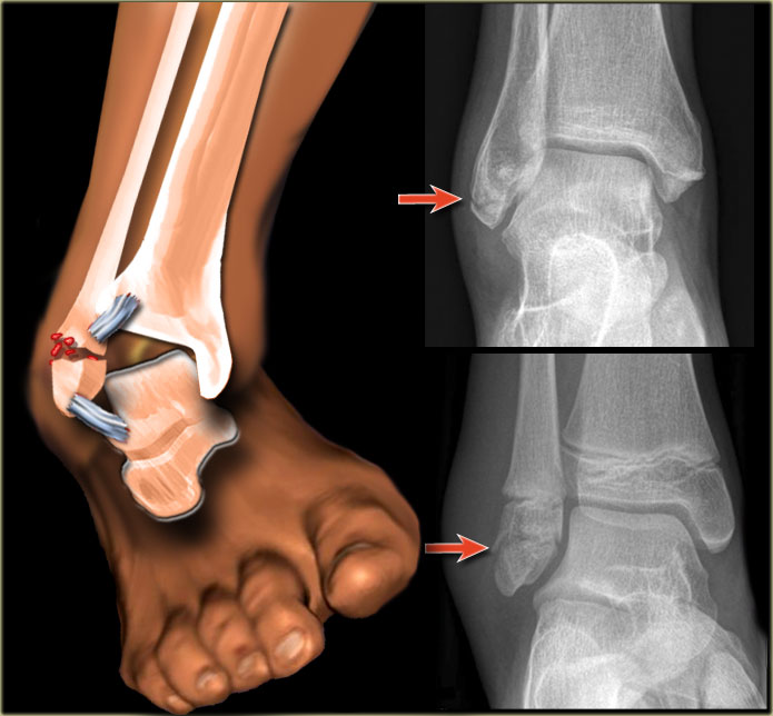 Sprained Ankle Vs Broken Ankle: Foot Specialist Breakdown