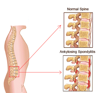 Iliopsoas Syndrome - Orthopaedic Spine Surgery Singapore