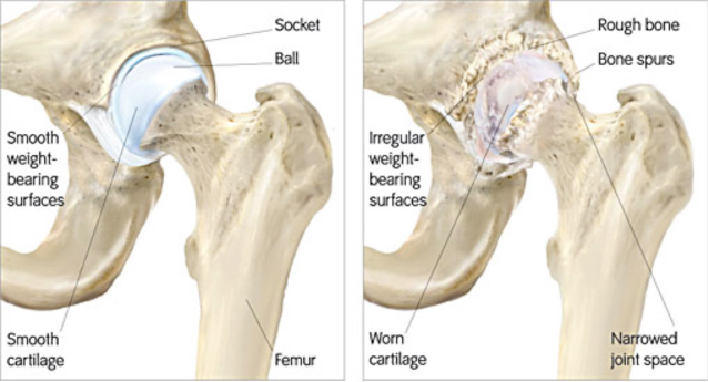 Hip Bone Spurs, Symptoms and Treatment