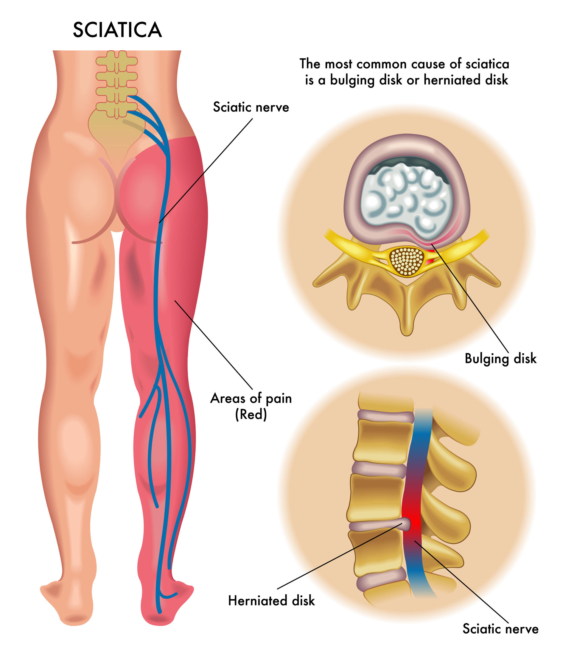 Sciatica Pain - Hip Pain Causes, Symptoms & Treatment