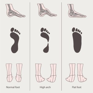 Do-you-have-flat-foot - Singapore Orthopaedic Clinic & Surgery