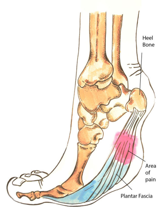 Plantar Fasciitis (Heel Pain) | Providence Orthopaedics