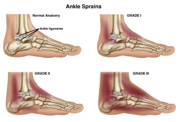 How to Treat a Sprained Ankle - AICA Orthopedics